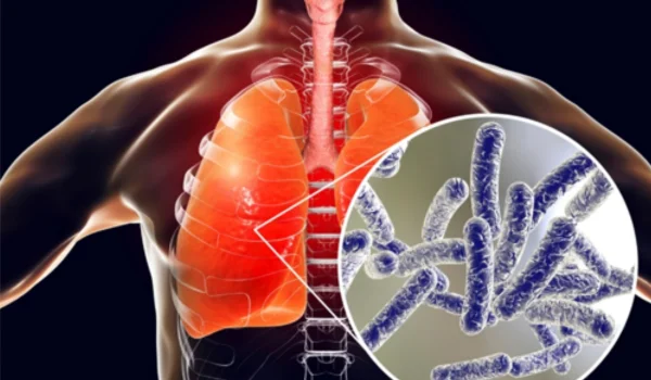 How to Prove Liability in a Legionnaires’ Disease Case in Houston